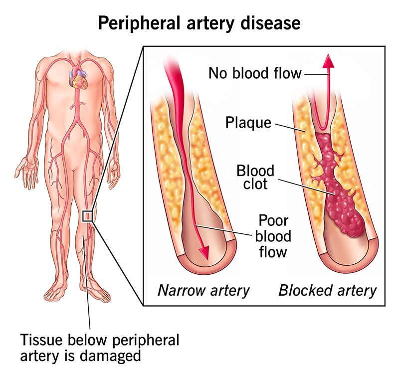 PAD symptoms showing leg pain and non-healing wounds